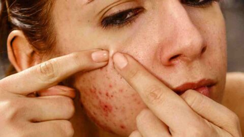 sho;uld i pop the acne